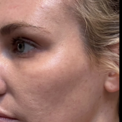 Microneedling Before & After Patient #7986