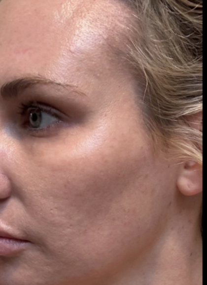 Microneedling Before & After Patient #7986