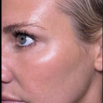 Microneedling Before & After Patient #7986