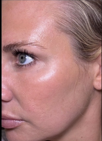 Microneedling Before & After Patient #7986