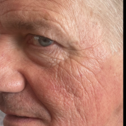Microneedling Before & After Patient #7987