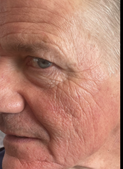 Microneedling Before & After Patient #7987