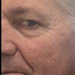 Microneedling Before & After Patient #7987