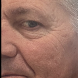 Microneedling Before & After Patient #7987