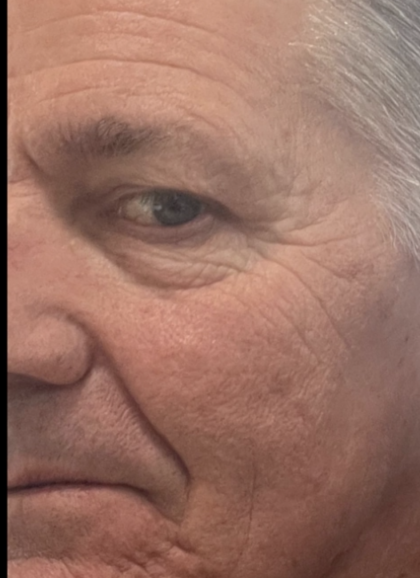 Microneedling Before & After Patient #7987
