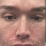 Microneedling Before & After Patient #7988