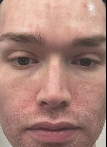 Microneedling Before & After Patient #7988