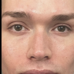 Microneedling Before & After Patient #7988