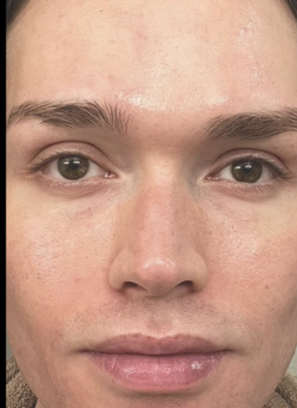Microneedling Before & After Patient #7988