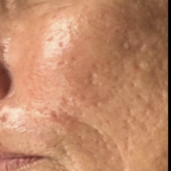 Microneedling Before & After Patient #7989