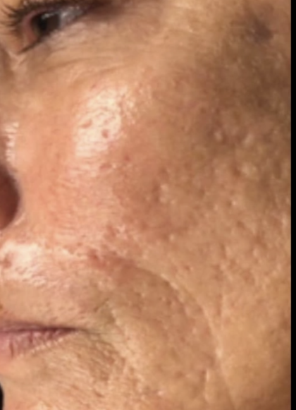 Microneedling Before & After Patient #7989