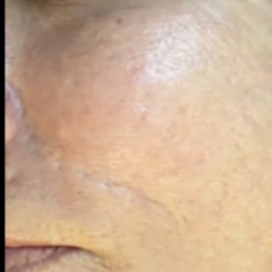 Microneedling Before & After Patient #7989