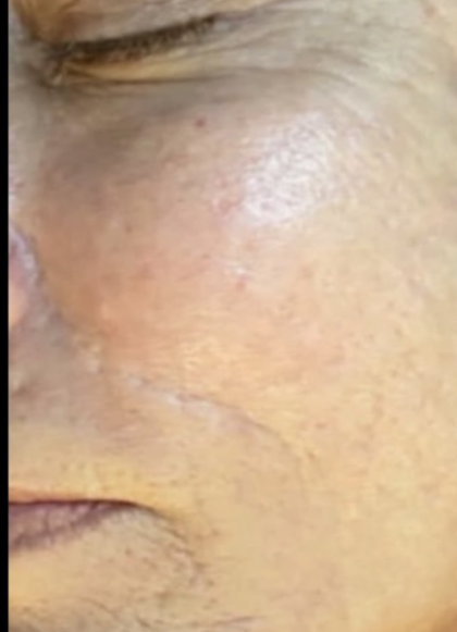 Microneedling Before & After Patient #7989
