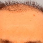 Hair Transplant Before & After Patient #8015