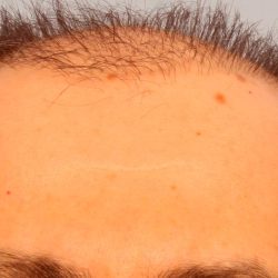Hair Transplant Before & After Patient #8015