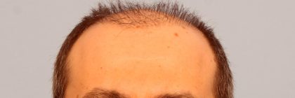 Hair Transplant Before & After Patient #8015
