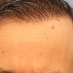 Hair Transplant Before & After Patient #8015