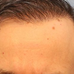 Hair Transplant Before & After Patient #8015