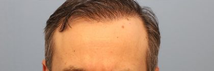Hair Transplant Before & After Patient #8015