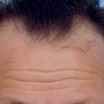 Hair Transplant Before & After Patient #8016