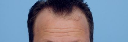 Hair Transplant Before & After Patient #8016