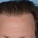 Hair Transplant Before & After Patient #8016