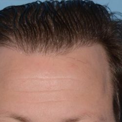 Hair Transplant Before & After Patient #8016