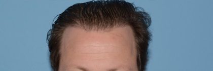 Hair Transplant Before & After Patient #8016