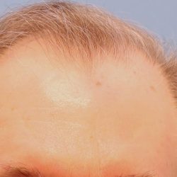 Hair Transplant Before & After Patient #8017