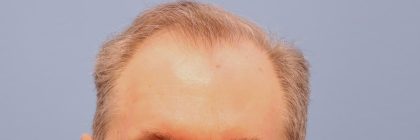 Hair Transplant Before & After Patient #8017