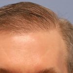 Hair Transplant Before & After Patient #8017