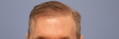 Hair Transplant Before & After Patient #8017