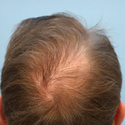 Hair Transplant Before & After Patient #8018
