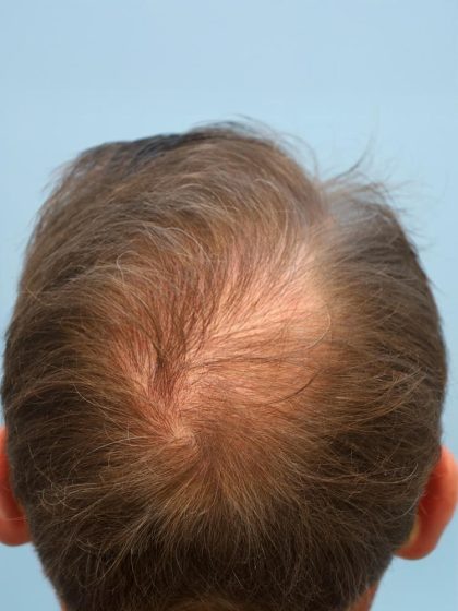 Hair Transplant Before & After Patient #8018