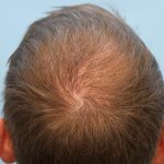 Hair Transplant Before & After Patient #8018