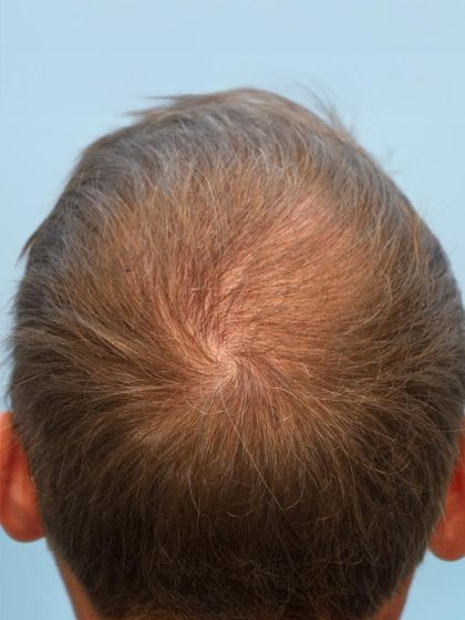 Hair Transplant Before & After Patient #8018
