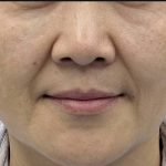 360 Lift Before & After Patient #8129