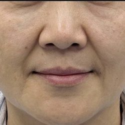 360 Lift Before & After Patient #8129