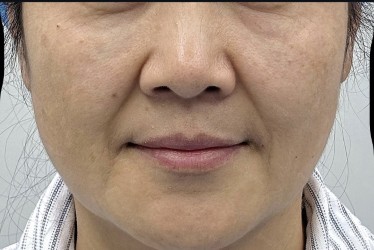 360 Lift Before & After Patient #8129