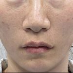 360 Lift Before & After Patient #8131