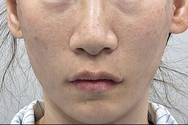 360 Lift Before & After Patient #8131