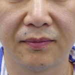 360 Lift Before & After Patient #8130