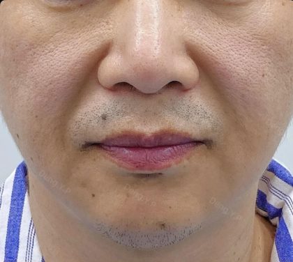 360 Lift Before & After Patient #8130