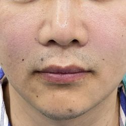 360 Lift Before & After Patient #8130