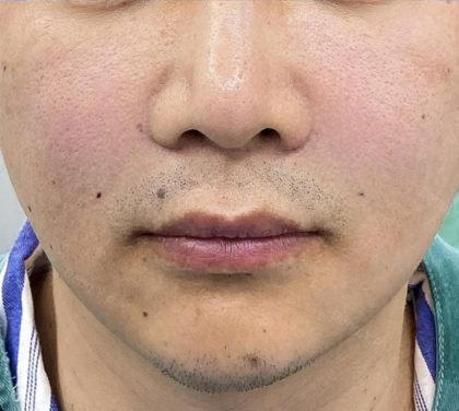 360 Lift Before & After Patient #8130