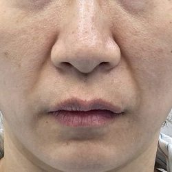 360 Lift Before & After Patient #8131