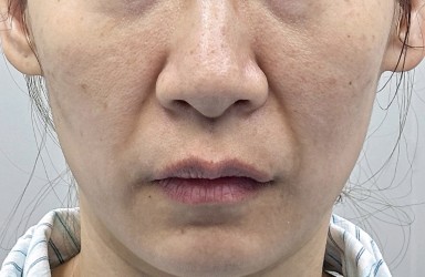 360 Lift Before & After Patient #8131