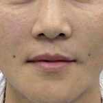 360 Lift Before & After Patient #8129