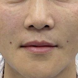 360 Lift Before & After Patient #8129