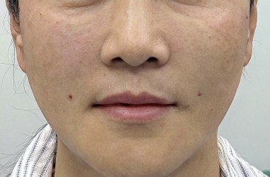 360 Lift Before & After Patient #8129